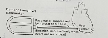 Fixed Rate Pacemaker What is A Pacemaker